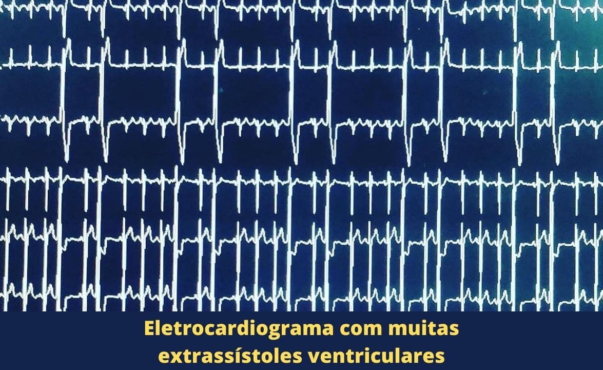 arritmia-em-uberlandia-eletrocardiograma-com-muitas-extrassístoles-ventriculares