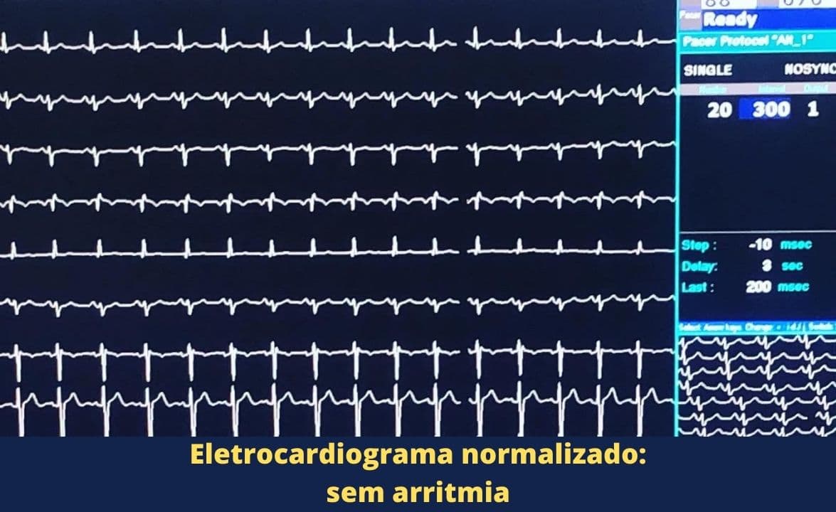 eletrocardiograma -normalizado-sem-arritmia-em-uberlandia