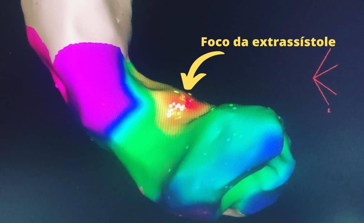 foco-da-extrassístole-arritmia-em-uberlandia