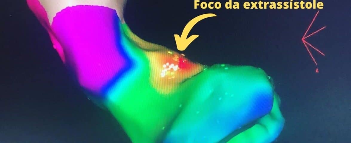 foco da extrassistole arritmia em uberlandia