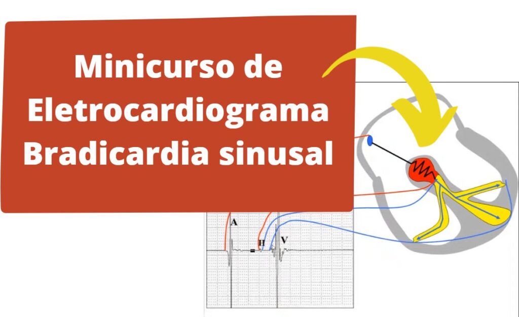 minicurso de eletrocardiograma bradicardia sinusal.blog