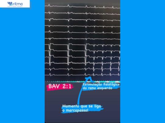 arritmia-em-uberlandia-marcapasso-fisiologico- (07) - 11-02