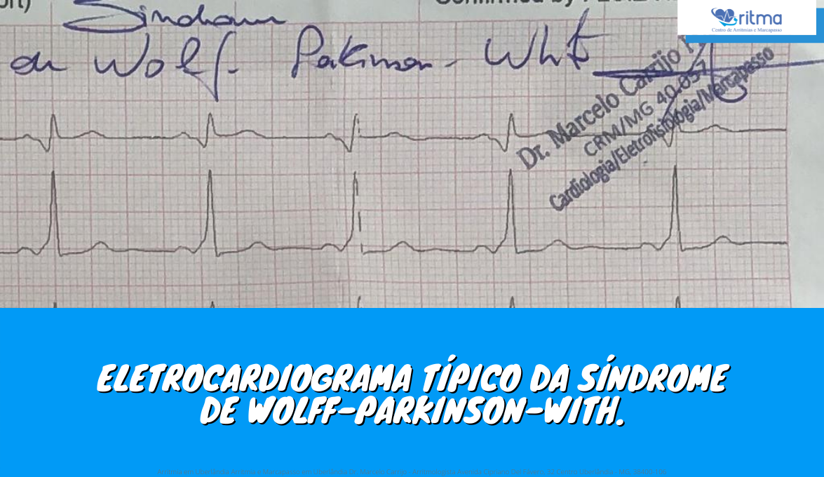 eletrocardiograma tipico da sindrome de wolf parkinson with